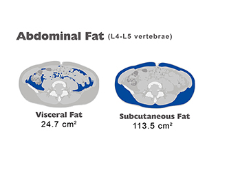 Análisis de grasa abdominal Análisis de grasa abdominal