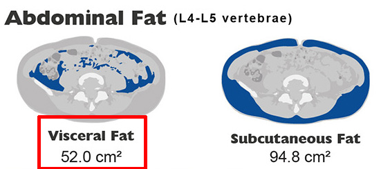 Abdominal Visceral Fat