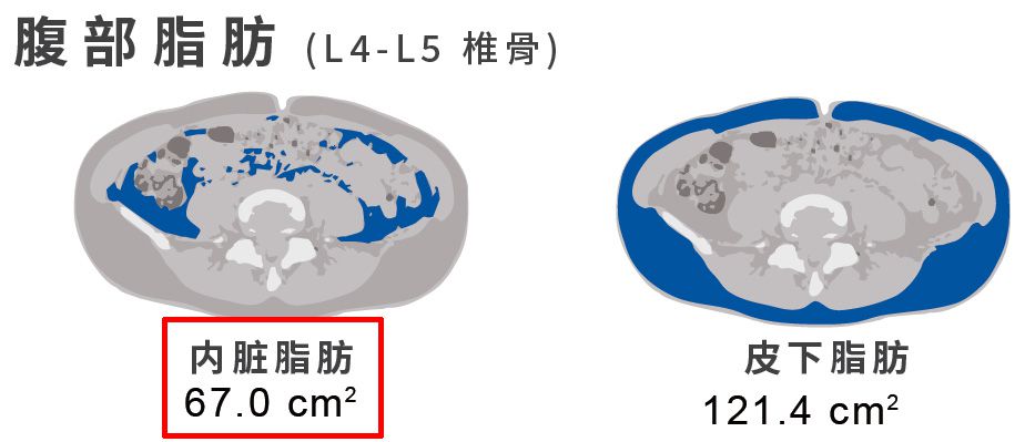 腹部内脏脂肪