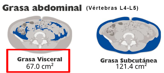 Abdominal Visceral Fat