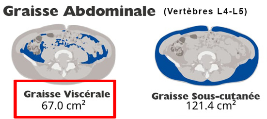 Abdominal Visceral Fat