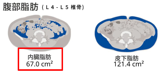 腹部內臟脂肪