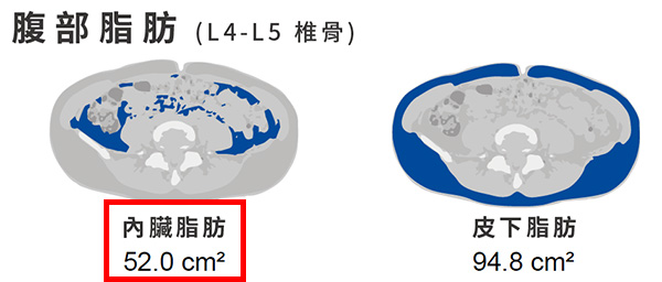 腹部內臟脂肪