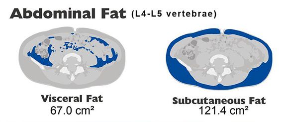 Visceral Fat Area for Medical Result Sheet