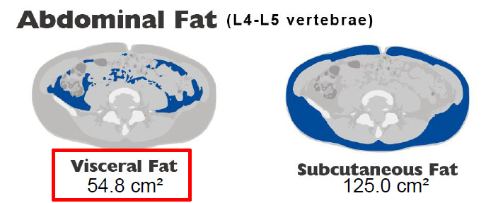 Visceral Fat