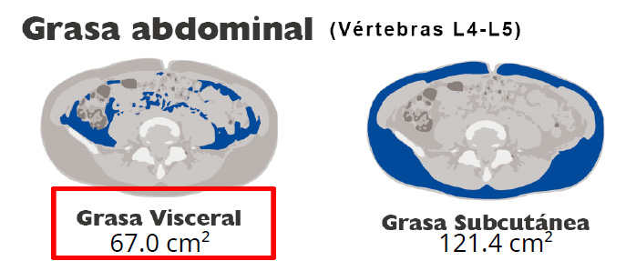 Visceral Fat