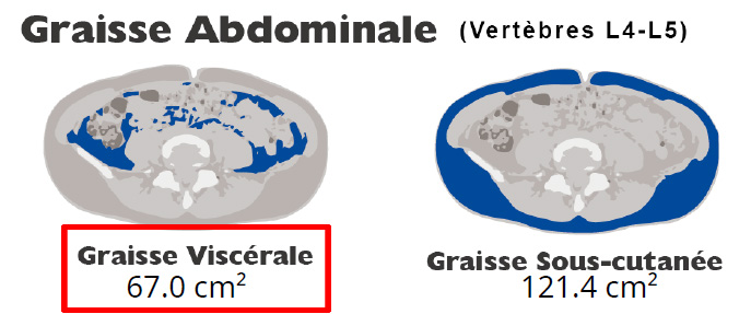 Visceral Fat