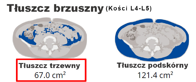 Tłuszcz trzewny